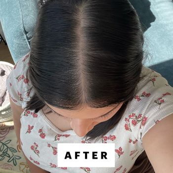 I Used PRP to Treat My Hair Loss