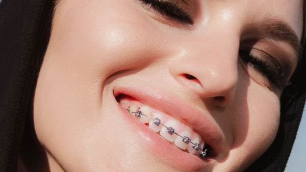 closeup of adult with wire braces